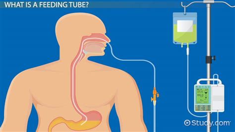 What Is A Feeding Tube? Types Complications Video Lesson, 45% OFF