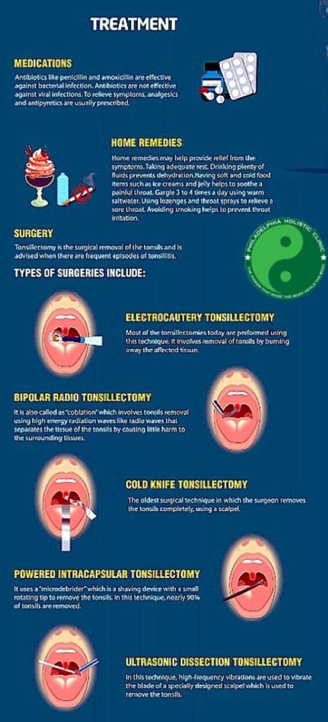 Treatment of Tonsillitis - Philadelphia Holistic Clinic - Dr. Tsan ...