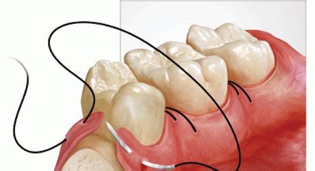 MedLT_gum_disease_surgery.png - Coconut Creek Dentist