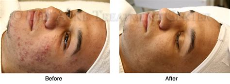 watermark-hyperpigmentation-acne-before-after2 | Acne Treatment Center | Portland OR, Oregon ...