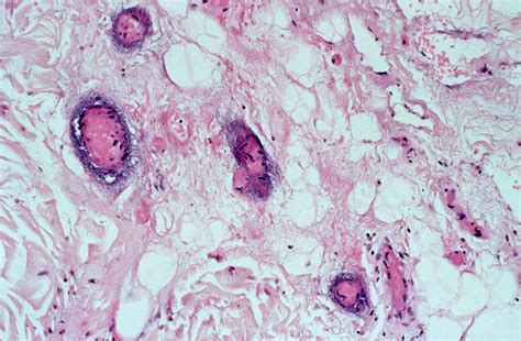 Pseudomonas Aeruginosa On Skin