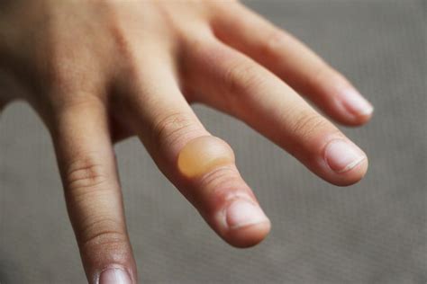 Burn blister: First aid, treatment, and types of burns