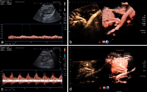 Diagnostic value of contrast-enhanced ultrasound (CEUS) in kidney allografts – 12 years of ...