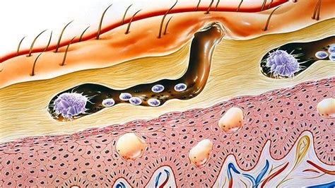 What Is Scabies? Symptoms, Causes, Diagnosis, Treatment, and Prevention