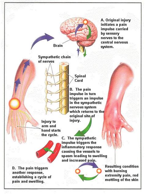 Shoulder Hand Syndrome Cause, Symptoms, Treatment