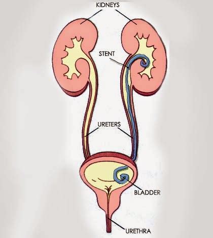 Brady Urology at Johns Hopkins Hospital: Ureteral Stents: Necessarily a ...