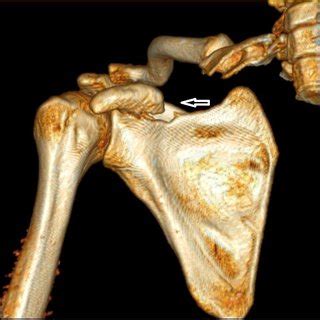 The CT scan image showing the displaced fracture coracoid. | Download Scientific Diagram