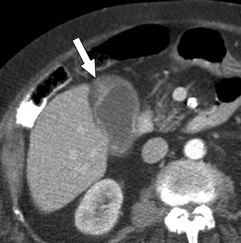 CT Differentiation of Adenomyomatosis and Gallbladder Cancer | AJR