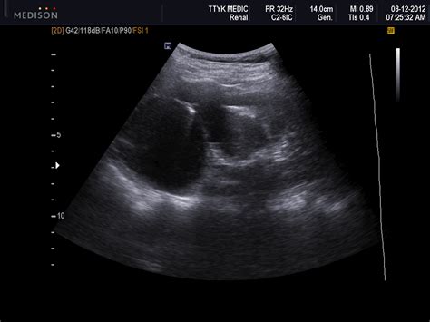 VIETNAMESE MEDIC ULTRASOUND: CASE 156: RENAL CYST or HYDRONEPHROSIS, Dr ...