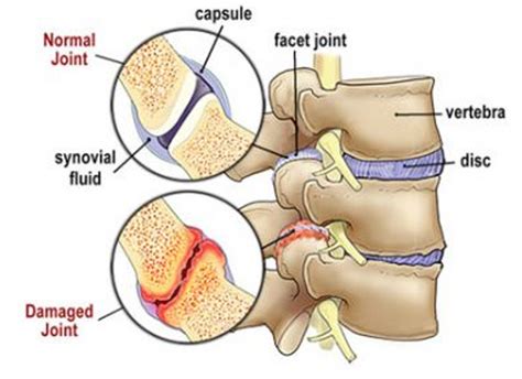 Facet syndrome - Chiropractor