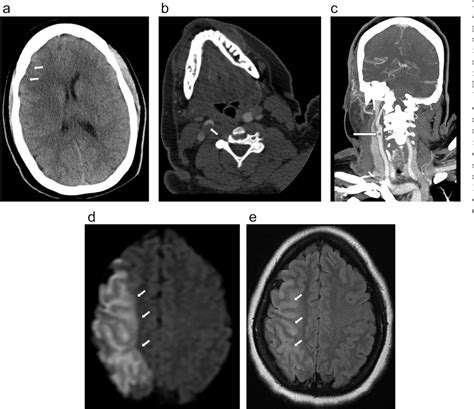 Figure 1 from Neurovascular complications that can be seen in COVID-19 patients | Semantic Scholar