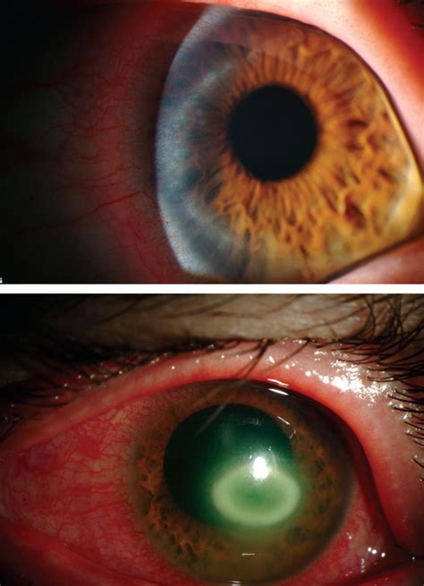 Your Corneal Infection Care Questions—Answered