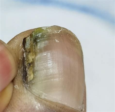 Hi guys need a help is this gangrene? Or fungus ingrown toenail? : r ...