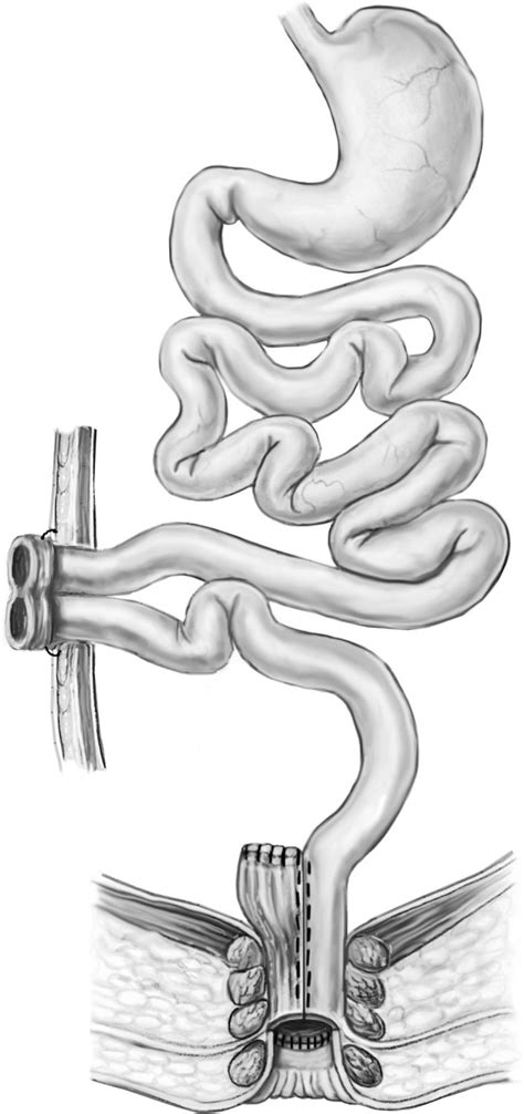 Restorative Proctocolectomy: The Current Ochsner Experience | Ochsner Journal