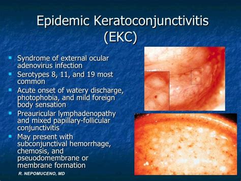 Ed&cornea lecture fatima