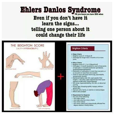 Pin by Kaelah Byrom on Health care | Ehlers danlos syndrome, Ehlers ...