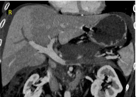 Splenic vein thrombosis CT scan - wikidoc