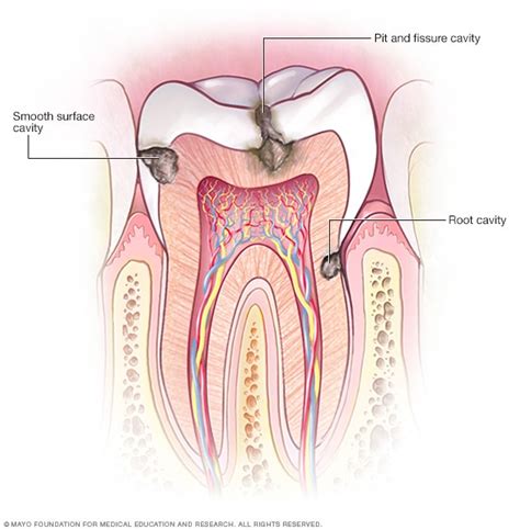 Cavities and tooth decay - Diagnosis and treatment - Mayo Clinic