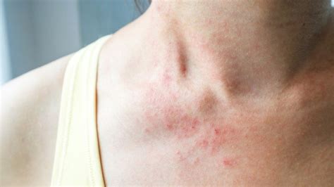 Stress Rash: Spotting & Treating It (Photo Examples)