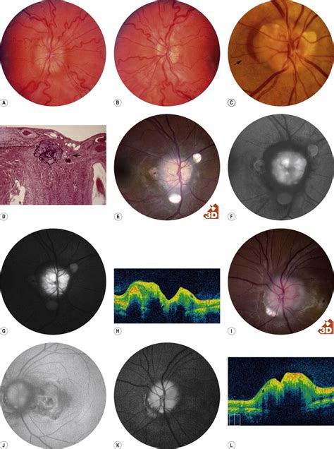 Optic Nerve Diseases that may Masquerade as Macular Diseases | Ento Key