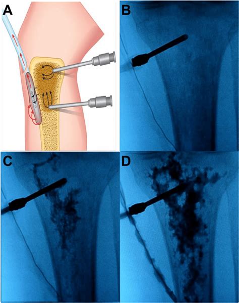 (A): Image of continuous local antibiotic perfusion (CLAP). (B, C, D):... | Download Scientific ...