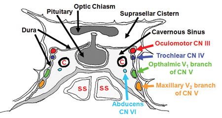 Cavernous Sinus Thrombosis-Signs symptoms-Diagnosis-Treatment and ...