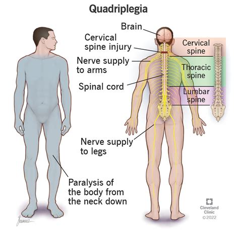 Cervical Spine Damage Symptoms