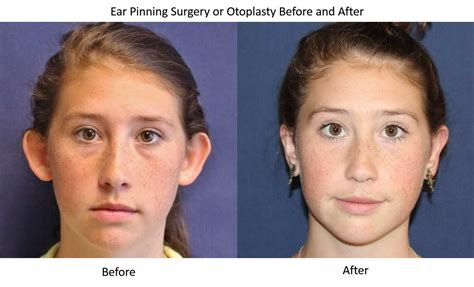 Otoplasty Seattle| Ear Pinning Surgery Kirkland | Dr Windle – DR. BRIAN ...