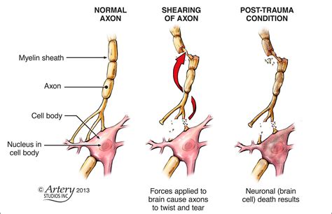 Diffuse Axonal Injury - Google Search | Tramatic brain injury, Brain ...