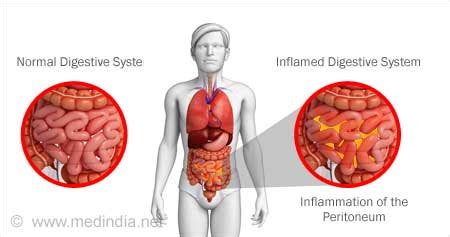 Ruptured Appendix Peritonitis