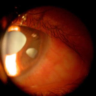 peripheral anterior synechiae in OD. Abbreviation: OD, right eye. | Download Scientific Diagram