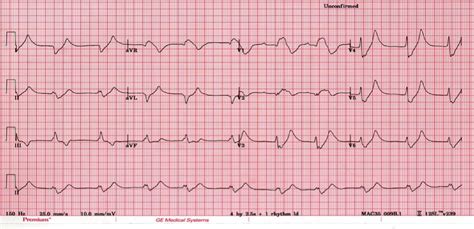 Hypermagnesemia Ecg Changes