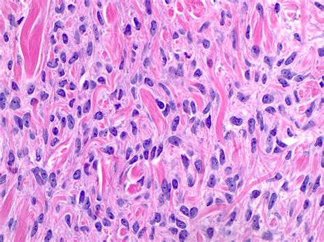 Fibroma Histology