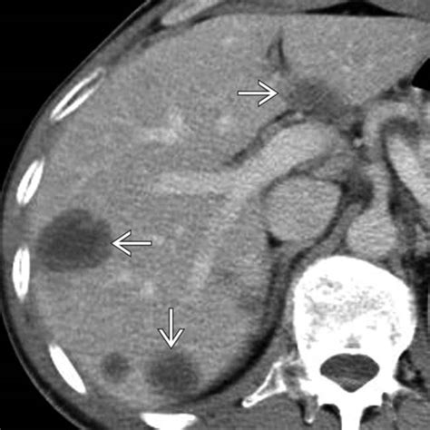 Epithelioid Hemangioendothelioma | Radiology Key