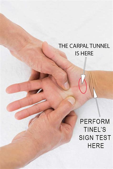 Self Test For Carpal Tunnel | The Carpal Solution