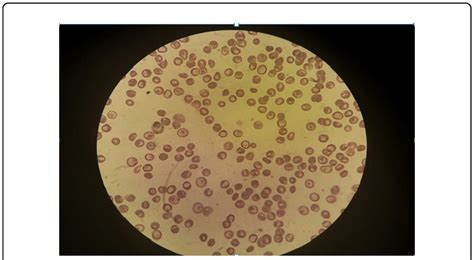 Microcytosis with target cells in cytomorphological examination of... | Download Scientific Diagram