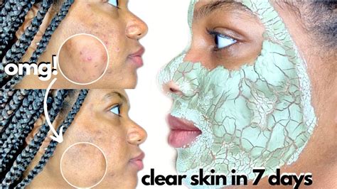 I Used The AZTEC INDIAN HEALING CLAY MASK Everyday to Clear Acne in One Week - Milan Alicia ...