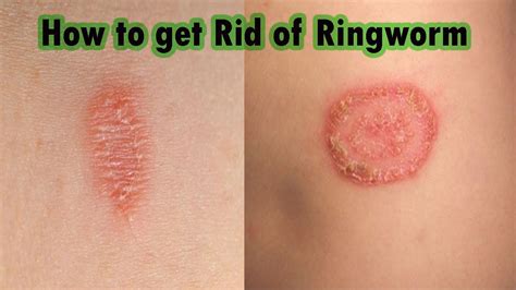 Ringworm Treatment At Home : 7 Steps on How to Cure Ringworm Fast ...