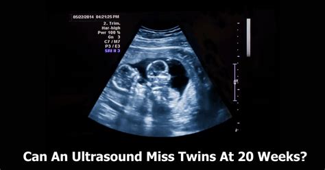 Can An Ultrasound Miss Twins At 20 Weeks? Experts' Insights 👶👶