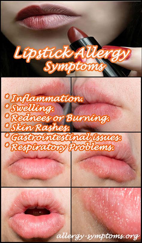 Lipstick Allergy Symptoms, Causes, and Treatment - Allergy Symptoms