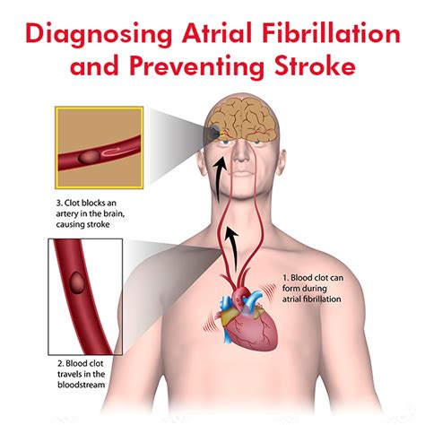 Diagnosing Atrial Fibrillation and Preventing Stroke – Dr Raghu