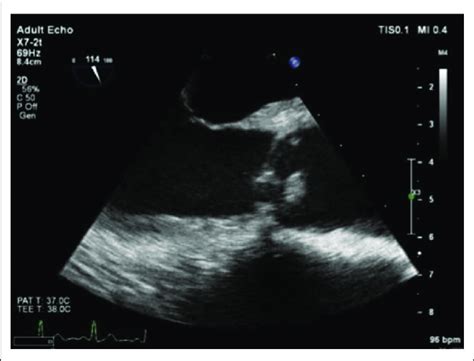 Transthoracic echocardiography showing a bicuspid aortic valve with ...