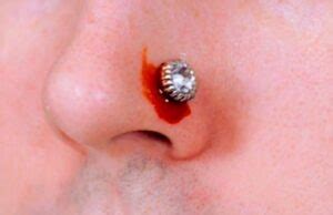 Infected Nose Piercing, Clean, Treat, Bump, Pics, Antibiotics, Symptoms, Remedies, Get Rid, Signs