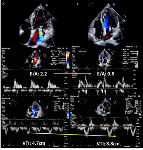 Frontiers | Value of Echocardiography in the Treatment of Patients With Acute Heart Failure