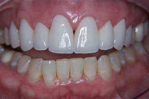 Before and After Dental Crowns Photos