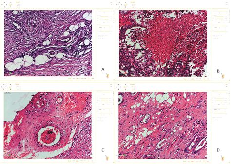 Histology findings in relapsed colorectal carcinoma patients (HE ...