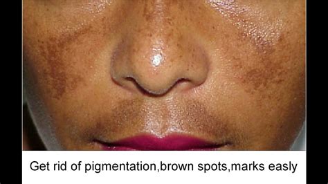 Face Pigmentation Treatment At Home - Doctor Heck