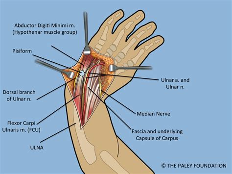 The Paley ulnarization of the carpus with ulnar shortening osteotomy for treatment of radial ...