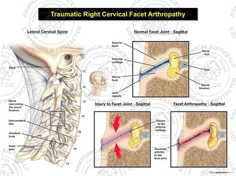 Traumatic Right Cervical Facet Arthropathy