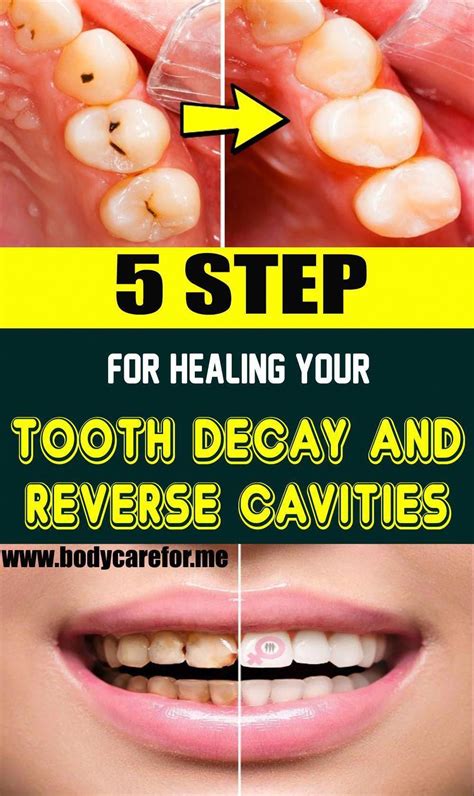 How to reverse tooth decay ayurveda information | alltheways